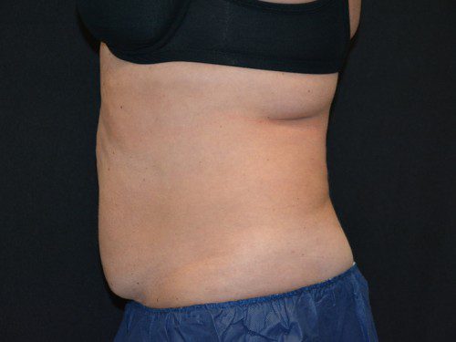 Coolsculpting Before Patient 4