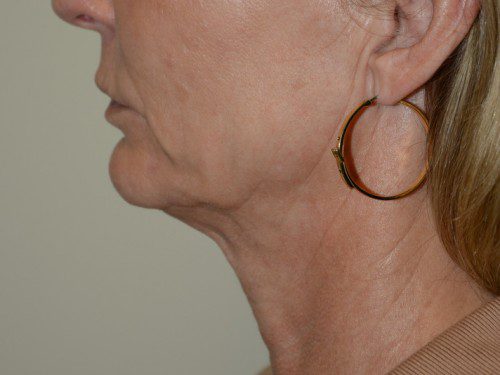 Facelift Before Patient 4