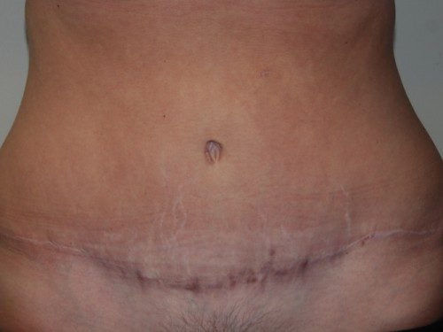 Tummy Tuck After Patient 1