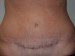 Tummy Tuck After Patient Thumbnail 1