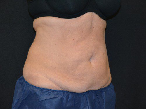 Coolsculpting Before Patient 3