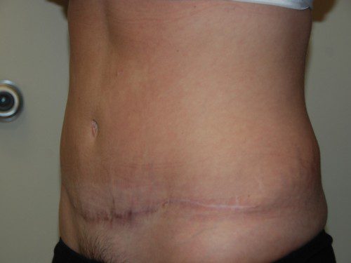 Tummy Tuck After Patient 2