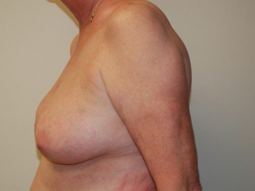 Breast Reconstruction Tissue Expanders Before Patient 5