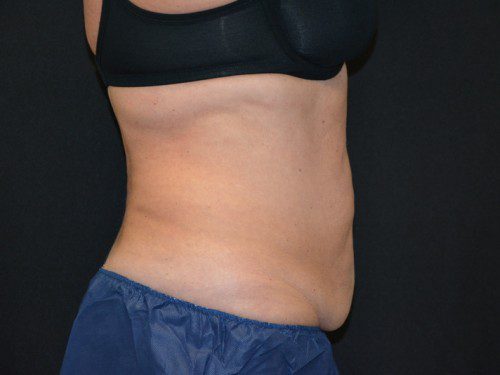 Coolsculpting Before Patient 5