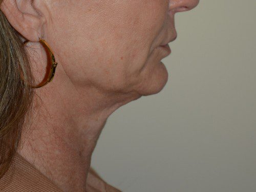 Facelift Before Patient 5