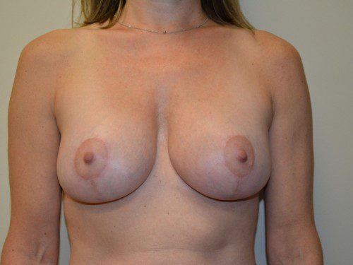 Breast Augmentation w/Lift After Patient 1