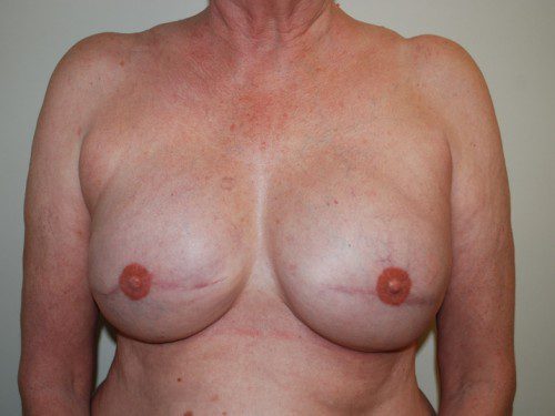 Breast Reconstruction Tissue Expanders After Patient 1