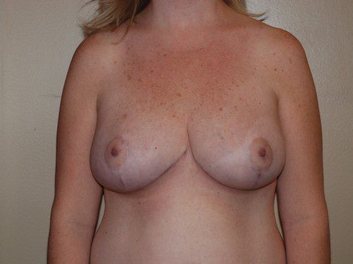Breast Reduction After Patient 1
