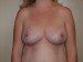 Breast Reduction After Patient Thumbnail 1