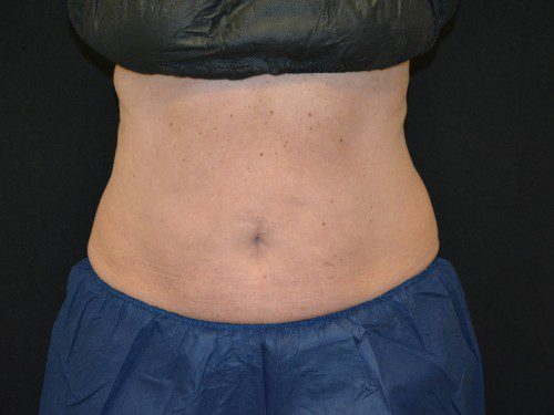 Coolsculpting After Patient 1