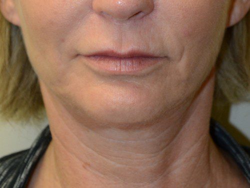 Facelift After Patient 1