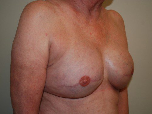 Breast Reconstruction Tissue Expanders After Patient 2