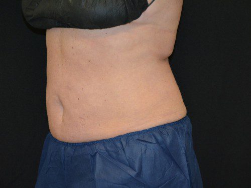 Coolsculpting After Patient 2