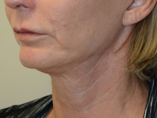 Facelift After Patient 2