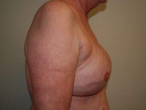 Breast Reconstruction Tissue Expanders After Patient 4