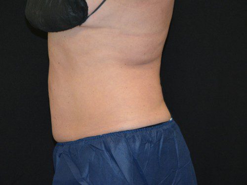 Coolsculpting After Patient 4