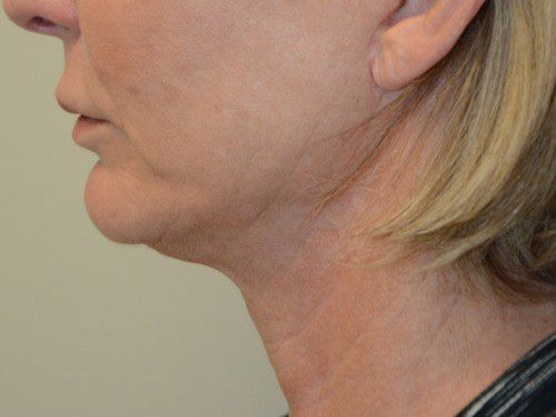 Facelift After Patient 4