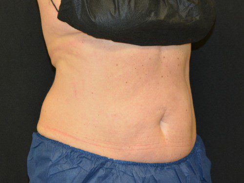 Coolsculpting After Patient 3