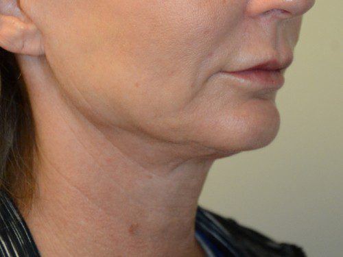 Facelift After Patient 3