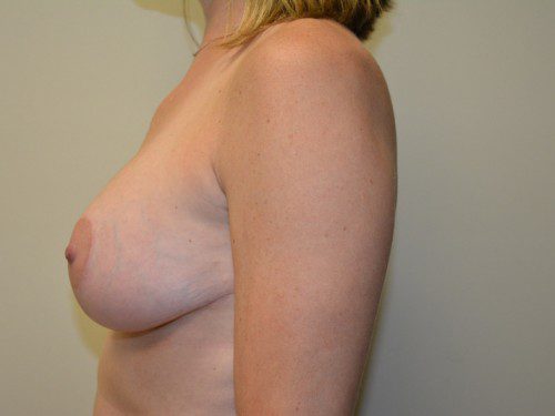 Breast Augmentation w/Lift After Patient 5