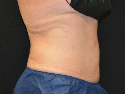 Coolsculpting After Patient 5