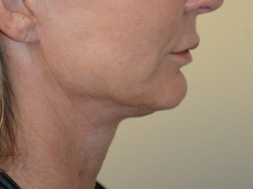 Facelift After Patient 5