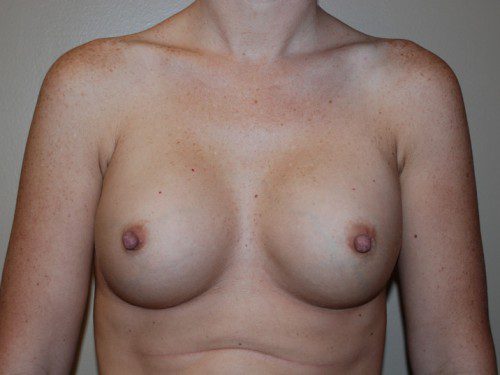 Breast Reconstruction Tissue Expanders Before Patient 1