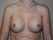 Breast Reconstruction Tissue Expanders Before Patient Thumbnail 1