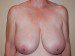 Breast Reduction Before Patient Thumbnail 1