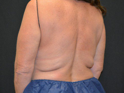 Coolsculpting Before Patient 2