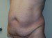 Tummy Tuck Before Patient Thumbnail 2