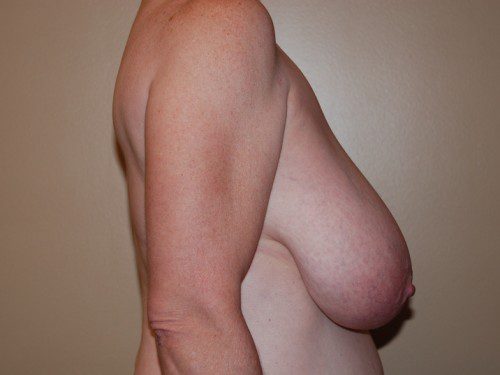 Breast Reduction Before Patient 4