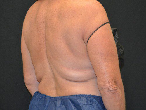 Coolsculpting Before Patient 3