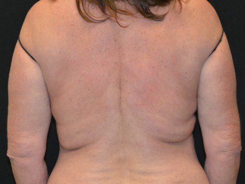 Coolsculpting After Patient 1