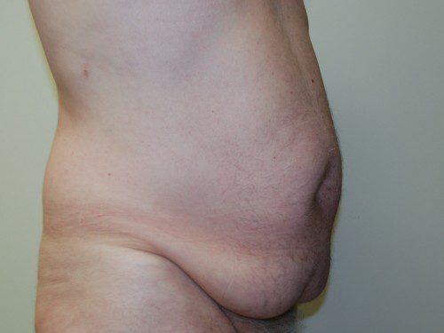 Tummy Tuck Before Patient 3