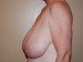 Breast Reduction Before Patient Thumbnail 5