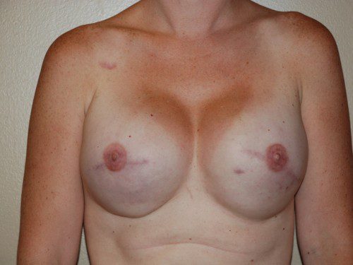 Breast Reconstruction Tissue Expanders After Patient 1