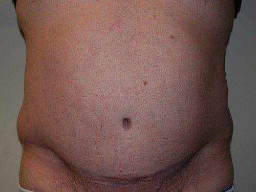 Tummy Tuck After Patient 1