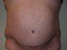 Tummy Tuck After Patient Thumbnail 1