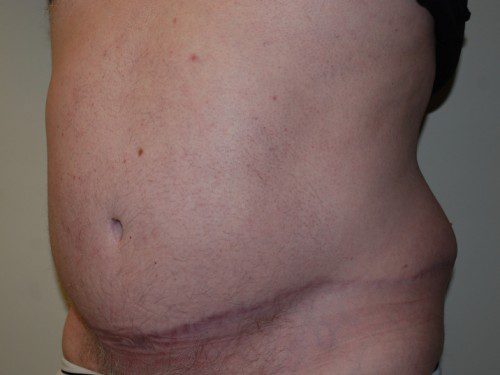 Tummy Tuck After Patient 2