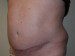 Tummy Tuck After Patient Thumbnail 2