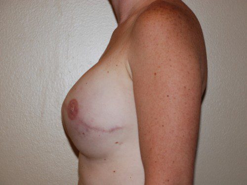 Breast Reconstruction Tissue Expanders After Patient 5