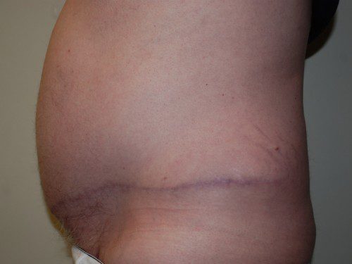 Tummy Tuck After Patient 4