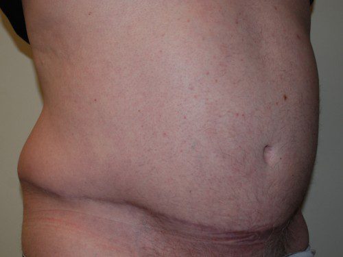 Tummy Tuck After Patient 3