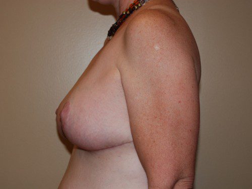 Breast Reduction After Patient 5