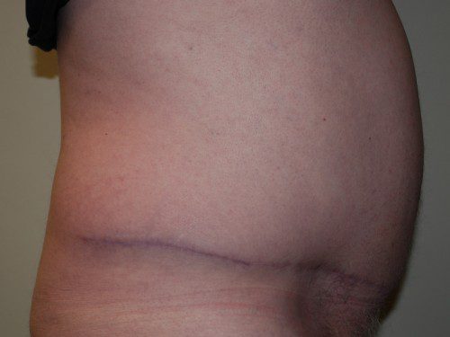 Tummy Tuck After Patient 5