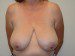 Breast Reduction Before Patient Thumbnail 1