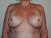 Breast Reconstruction Tissue Expanders After Patient Thumbnail 1