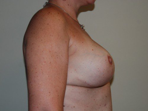 Breast Reconstruction Tissue Expanders After Patient 4