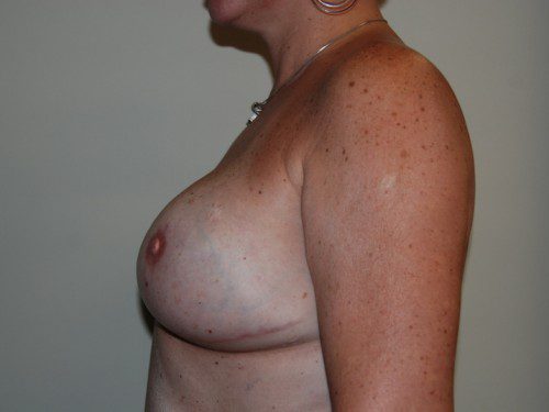 Breast Reconstruction Tissue Expanders After Patient 5